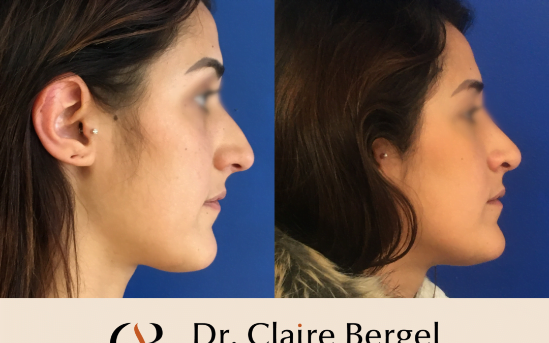 Rhinoplastie par voie ouverte ou par voie fermée : qu’est-ce que cela signifie ? Que choisir ?