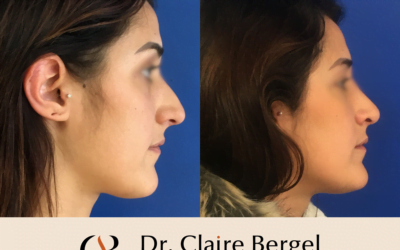 Rhinoplastie par voie ouverte ou par voie fermée : qu’est-ce que cela signifie ? Que choisir ?